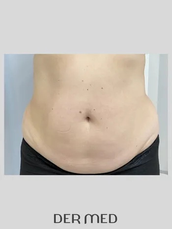 lipo przed