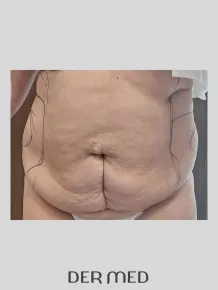 Liposukcja boczki przed