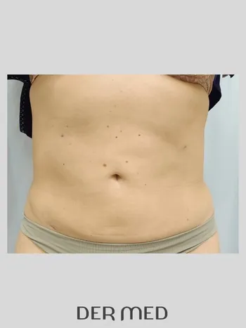 lipo po