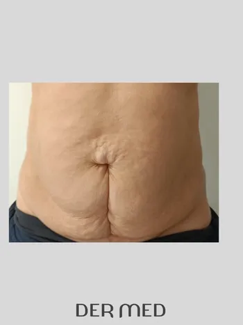 Liposukcja boczki po
