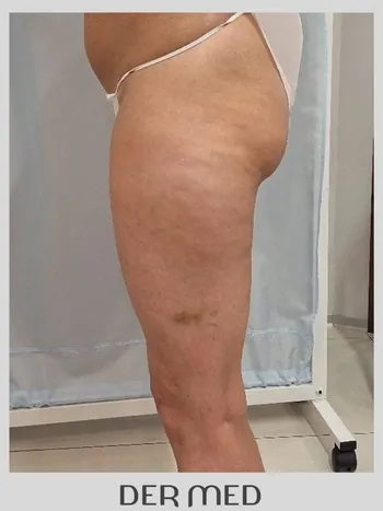 uda liposukcja przed