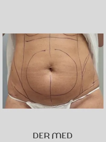 liposuka brzucha przed