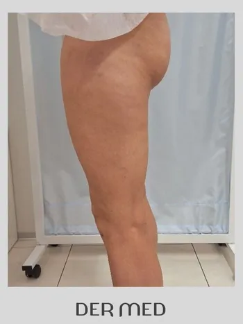 Uda liposukcja po